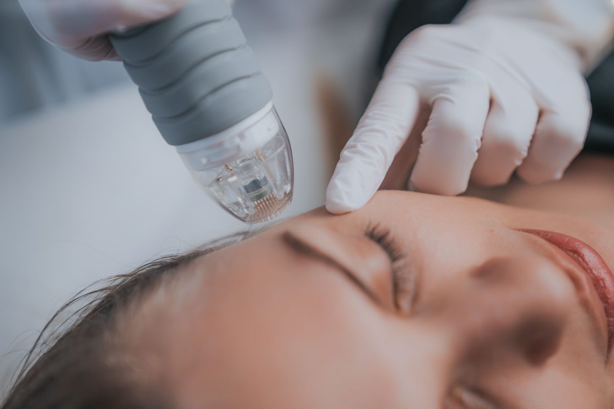 Dermapen: Tratamientos de Microneedling Facial y Corporal