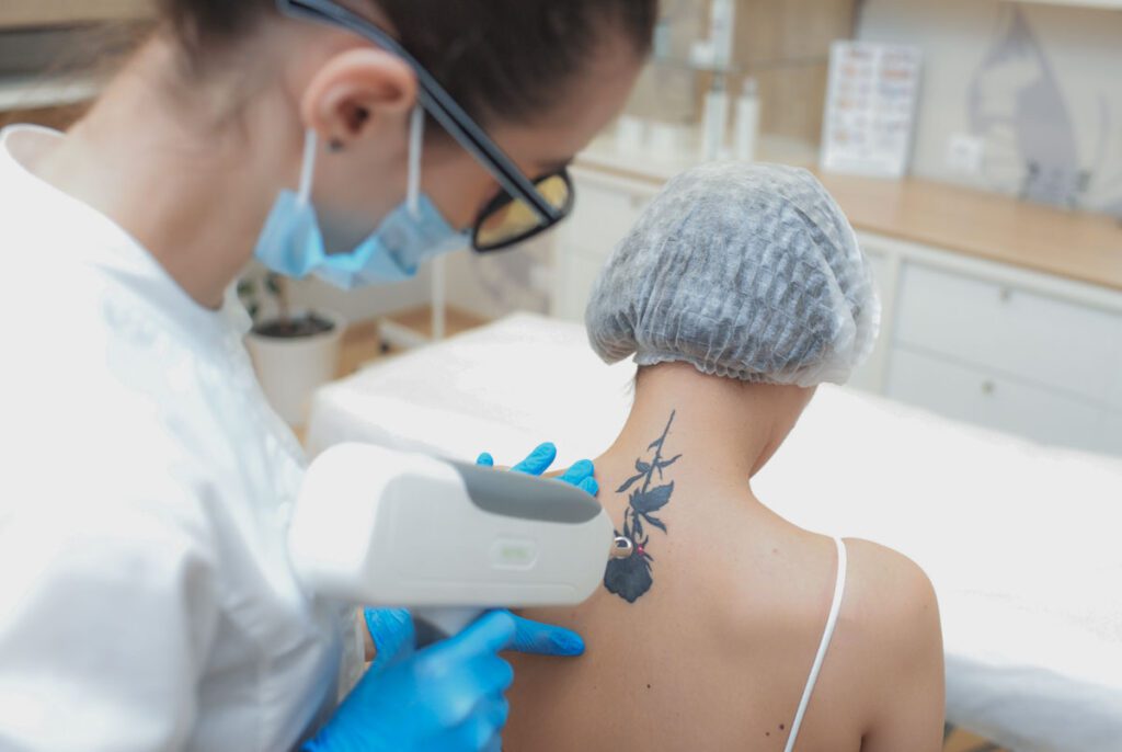 Eliminación de tatuajes con láser