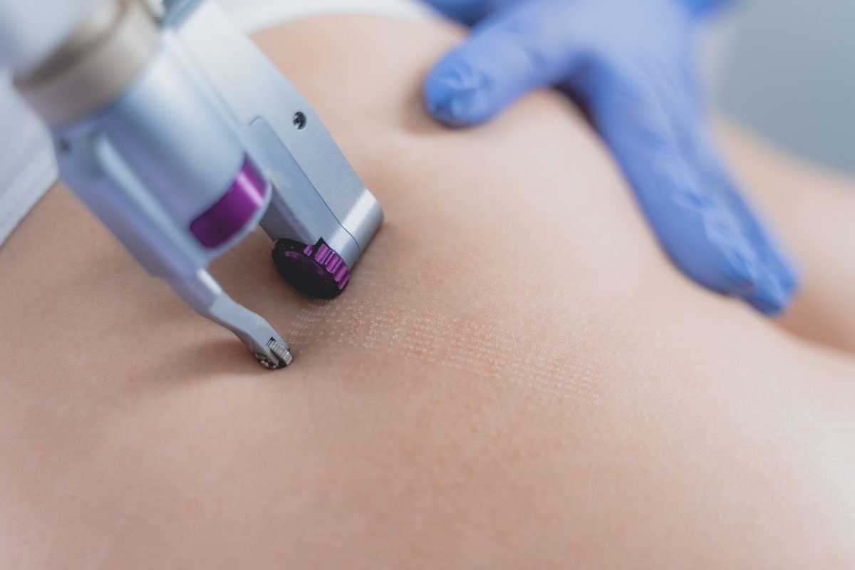 Especialista en Aparatología Corporal: mesoterapia, presoterapia y cavitación estética