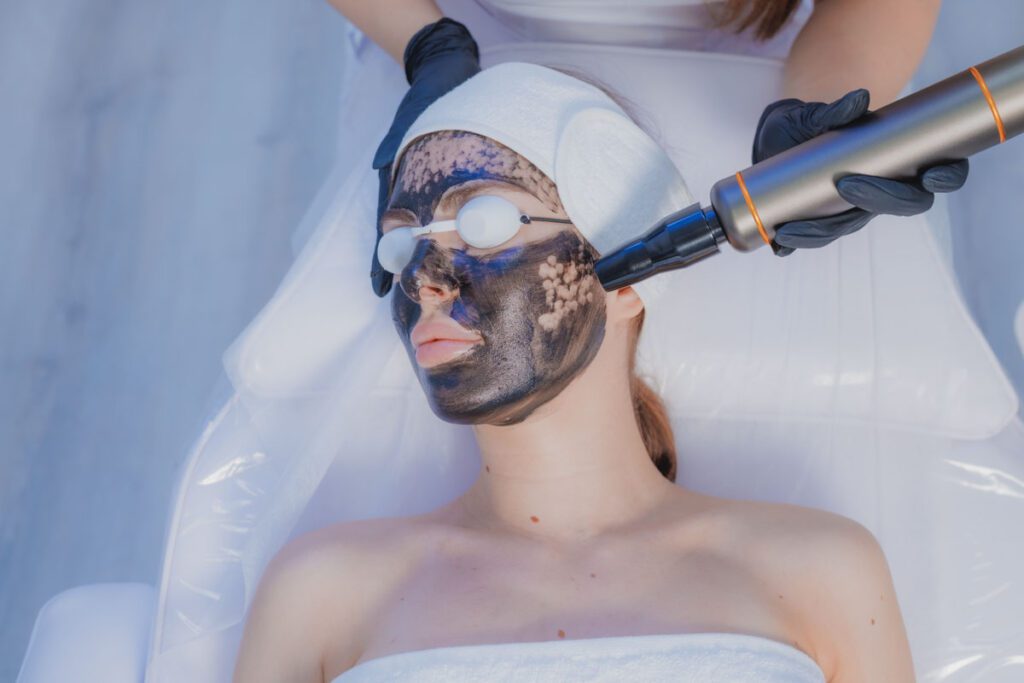 Hollywood Peel (Carbon Peel)