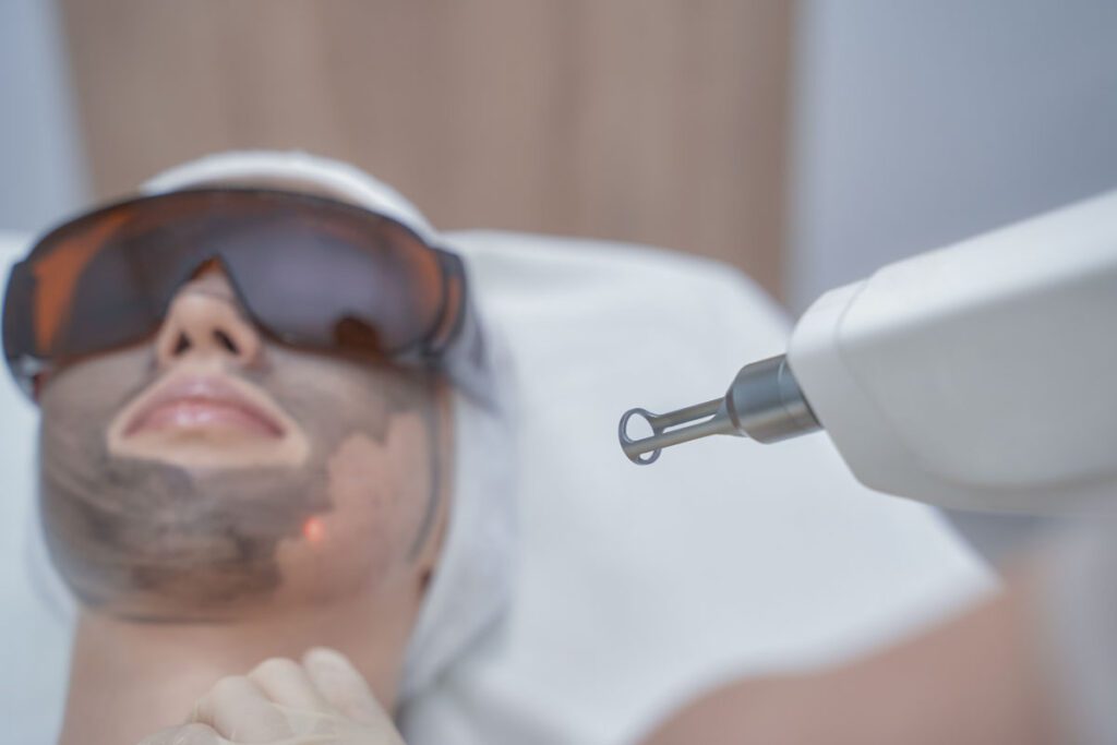 Hollywood Peel (Carbon Peel)