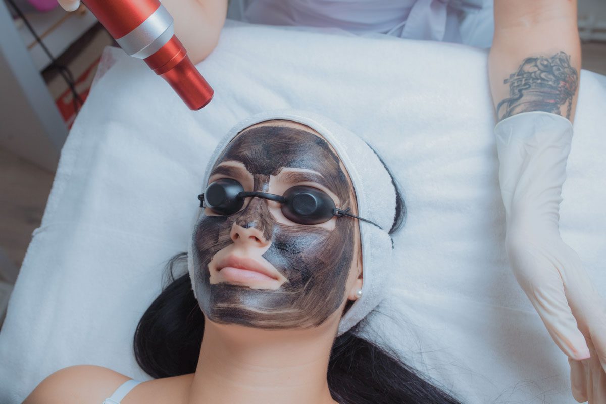 Hollywood Peel (Carbon Peel)