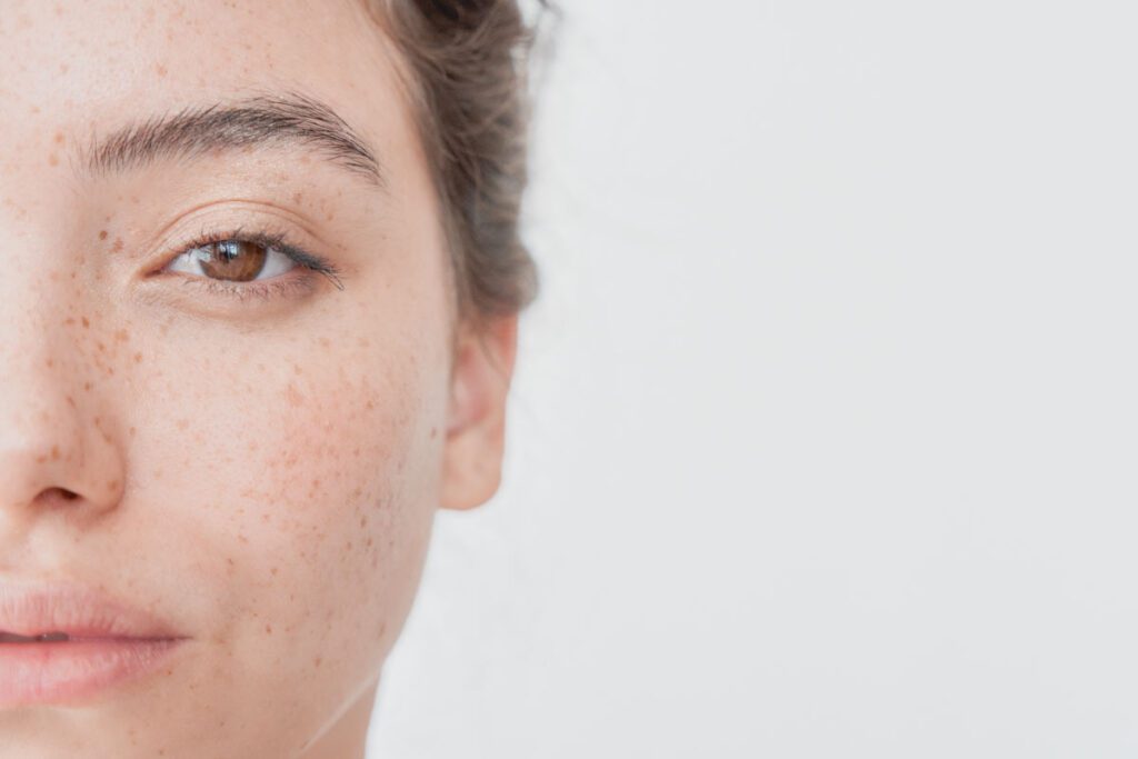 Micropigmentación de Pecas (Freckling)