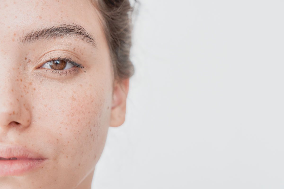 Micropigmentación de Pecas (Freckling)