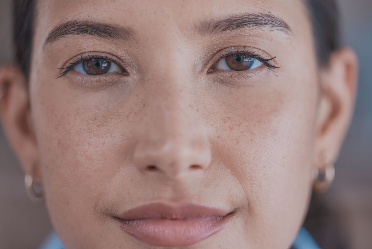 Micropigmentación de Pecas (Freckling)