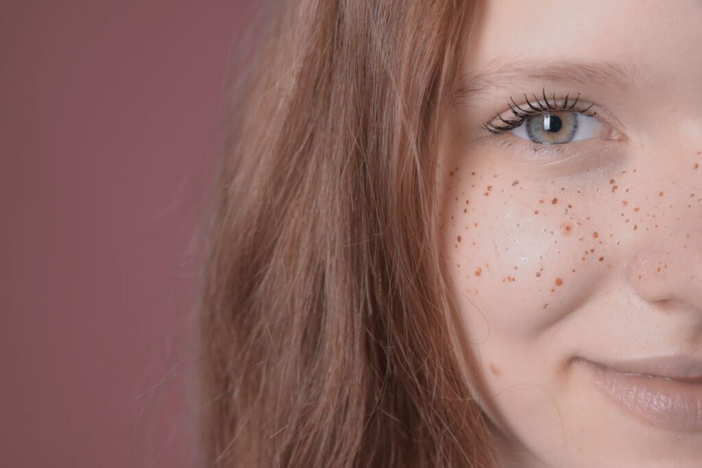 Micropigmentación de Pecas (Freckling)