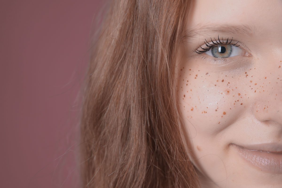 Micropigmentación de Pecas (Freckling)