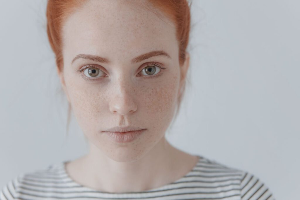 Micropigmentación de Pecas (Freckling)