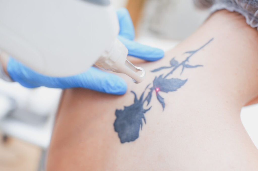 Eliminación de tatuajes con láser