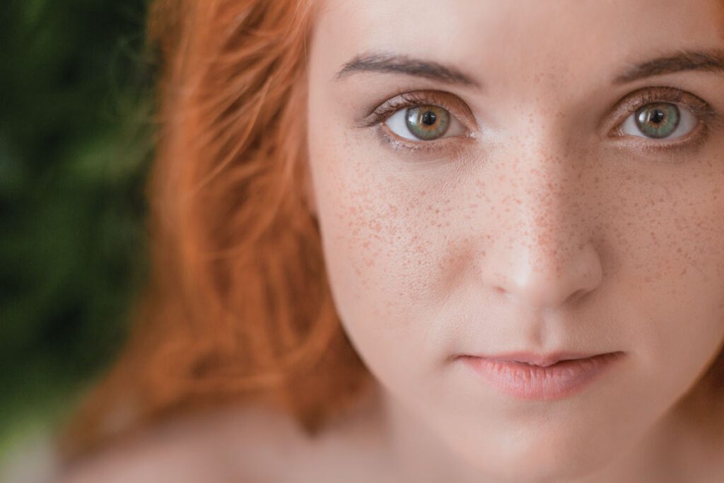 Micropigmentación de Pecas (Freckling)