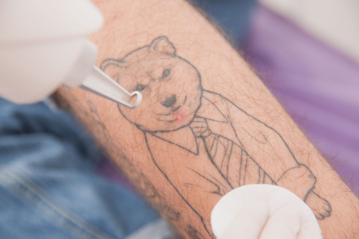 Eliminación de tatuajes con láser