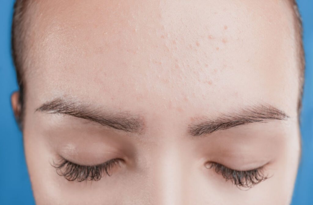 Micropigmentación de Pecas (Freckling)