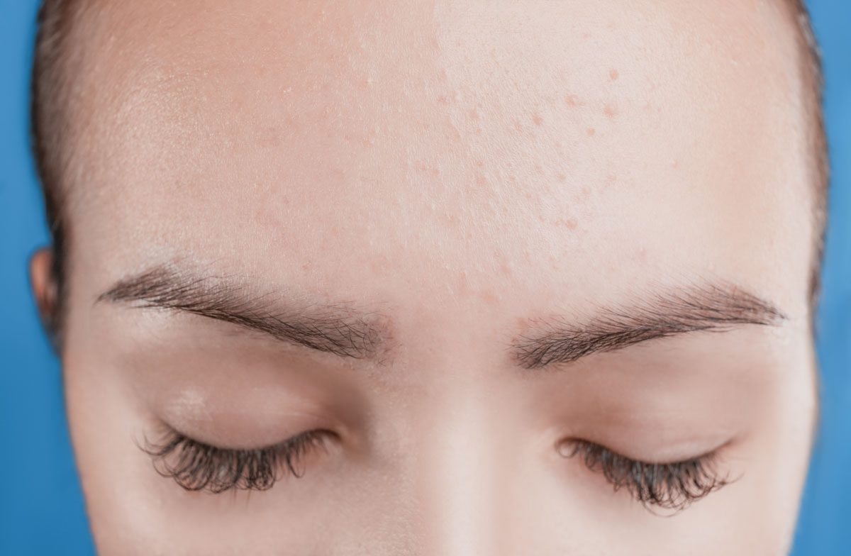 Micropigmentación de Pecas (Freckling)